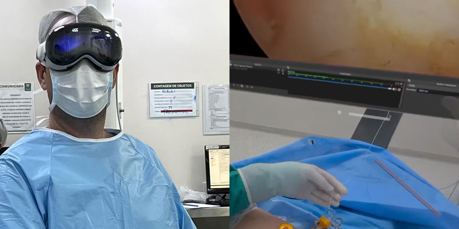Apple Vision Pro использовался для помощи врачу во время операции артроскопии плеча в Бразилии